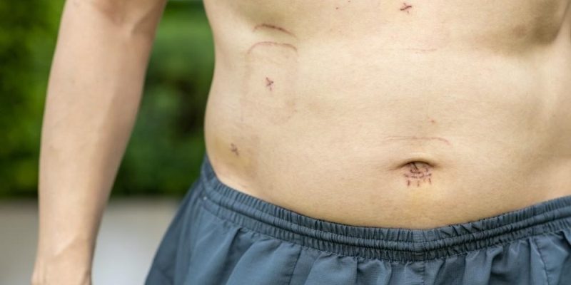 Gallstones Removal Singapore