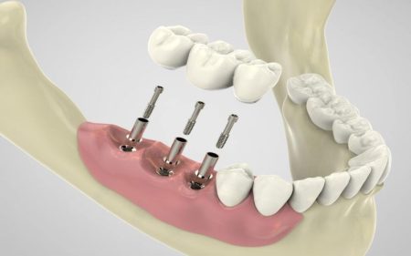 4 Steps In The Dental Implant Placement Process