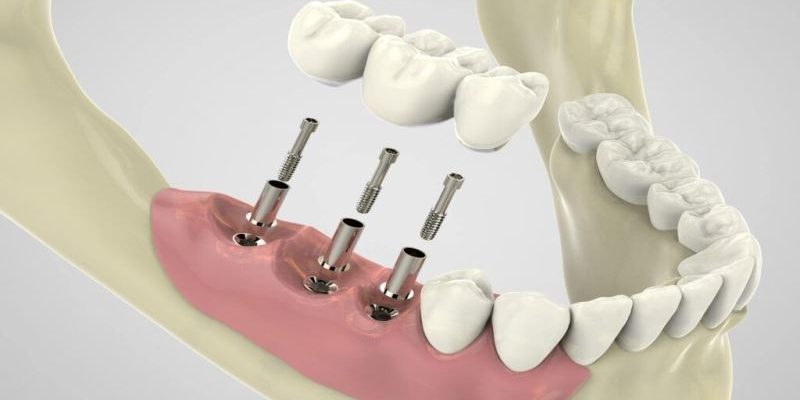 4 Steps In The Dental Implant Placement Process
