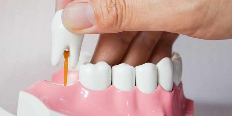 Why Dental Implants Are A Permanent Solution For Missing Teeth