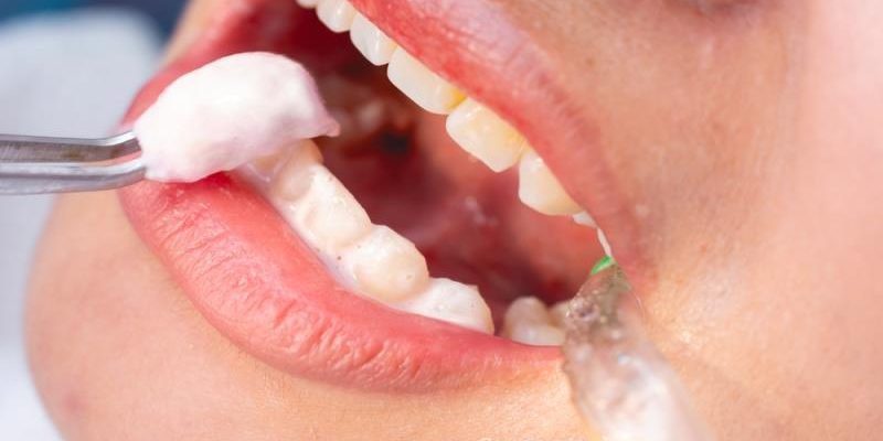 Fluoride Applications