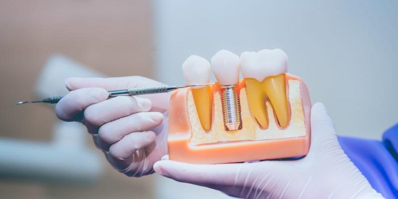 Dental Implant
